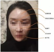 女模特额头被打现凹坑，索赔十万，刚打了10支玻