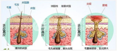 激光去痘印会不会留下疤痕呢？